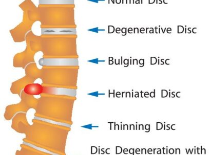 איור של עמוד שדרה במצבים בריאותיים שונים